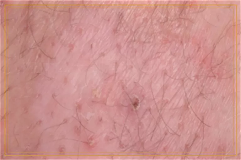 为什么一到春天白癜风就复发增多