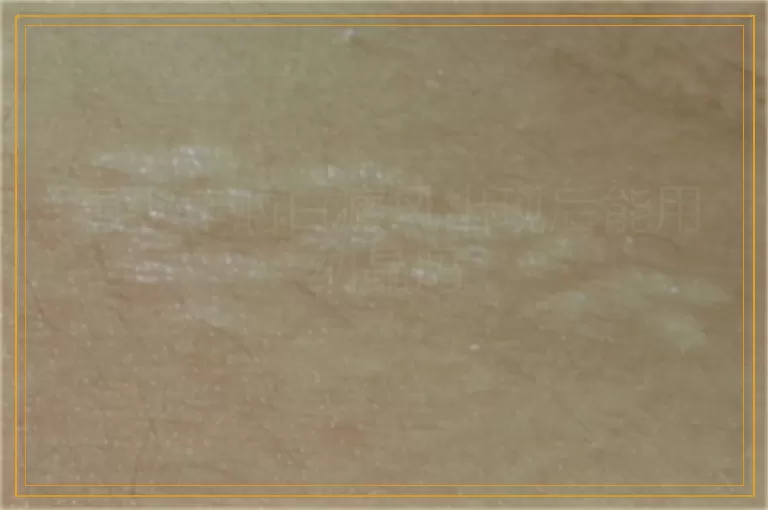 青少年的白癜风出现后能用纳晶吗