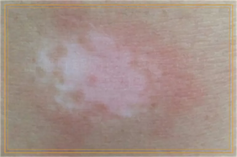 伍德灯能确诊白斑是不是白癜风吗