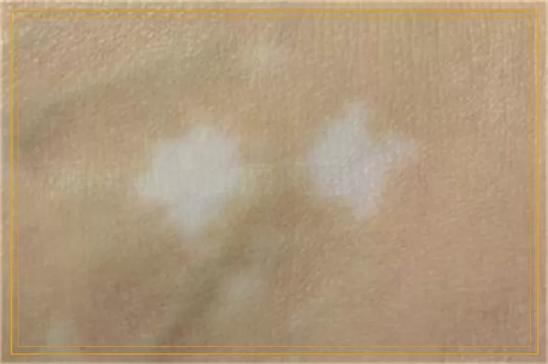 发展期的白癜风要怎么治疗