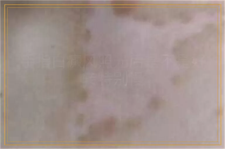 手指白癜风照光后是不是好转特别慢