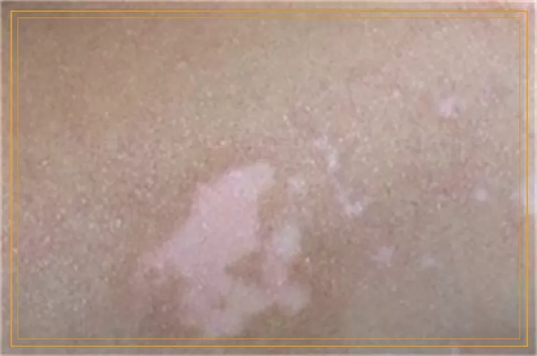 胳膊上长白斑是什么原因该怎么治