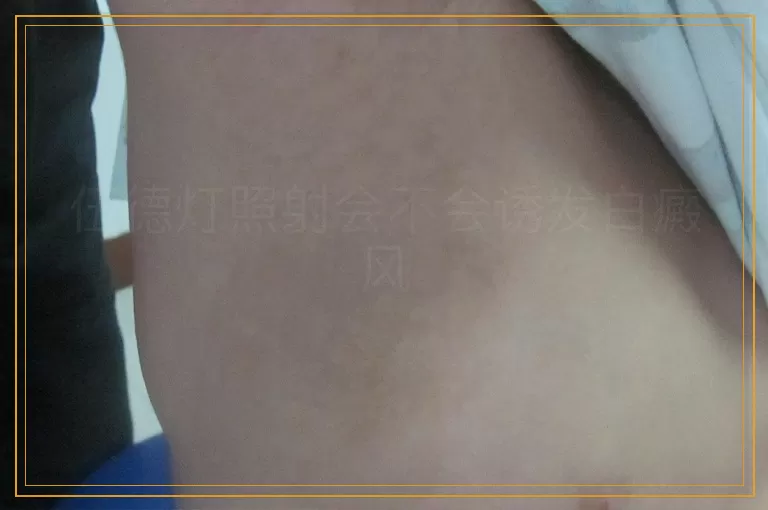 伍德灯照射会不会诱发白癜风