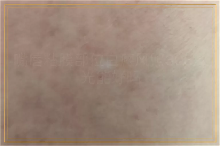 嘴唇粘膜部位白癜风照308激光能好吗