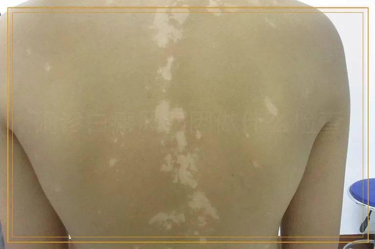 确诊白癜风病因做什么检查