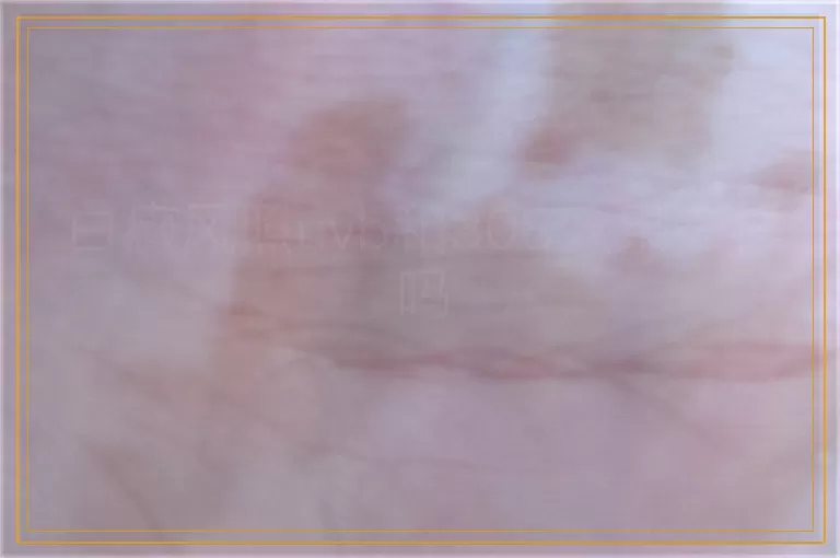 白癜风照uvb和308效果一样吗