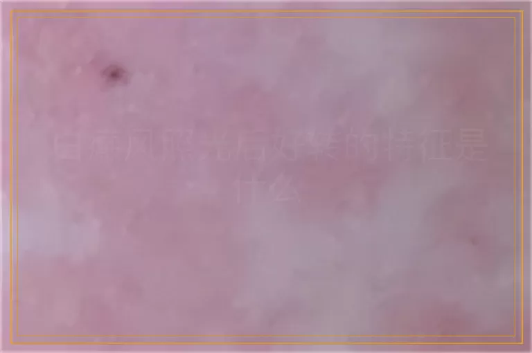 白癜风照光后好转的特征是什么