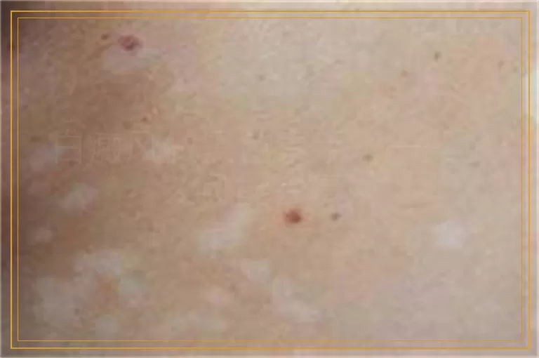 白癜风做黑色素手术一般多久可能会复发