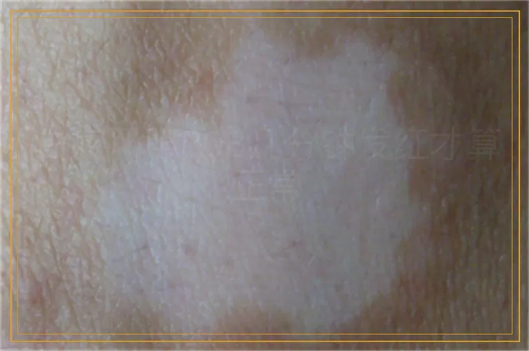 白癜风照308几分钟发红才算正常