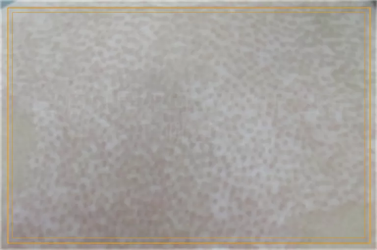 白癜风是如何出现的病因有哪些