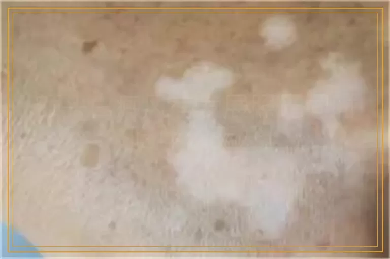 额头白癜风有发展照光同时吃什么药好