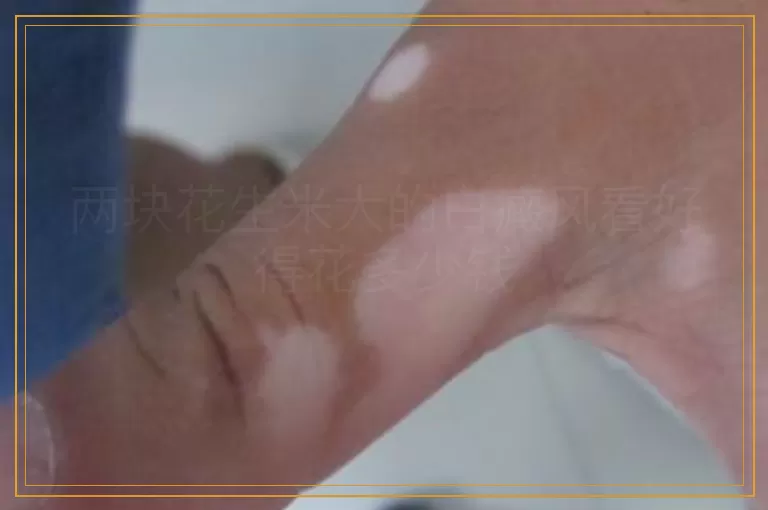 两块花生米大的白癜风看好得花多少钱