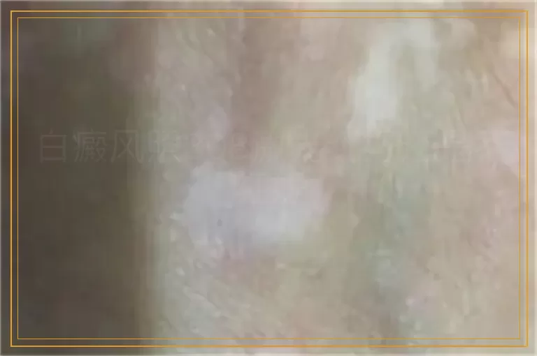 白癜风照308激光红好还是不红好