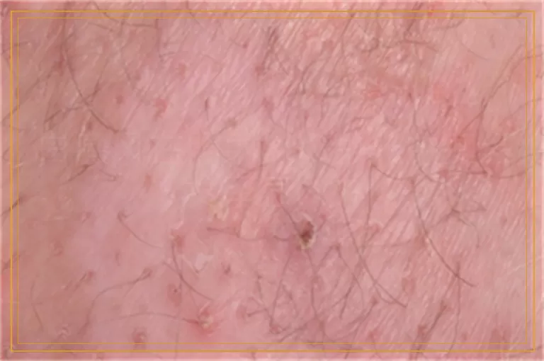 白癜风在照射308激光中变红发痒怎么办