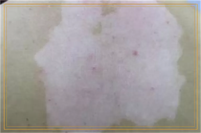 左眼下睫毛那的皮肤变白了是不是白癜风