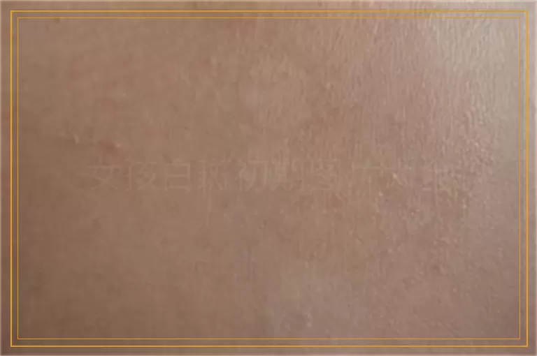 女孩白斑初期图片大全