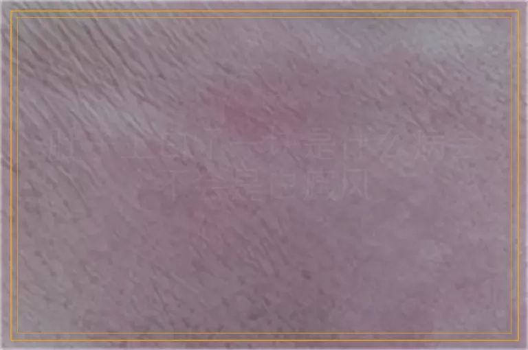 肚子上白了一块是什么病会不会是白癜风