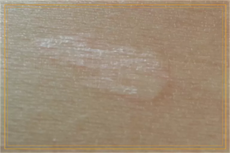 白癜风稳定两月后为什么又扩散了