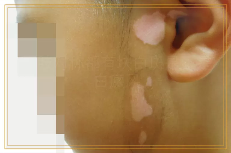 四肢对称都有块白斑是不是白癜风