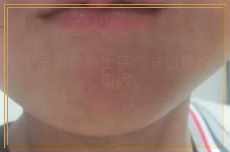 七岁男孩脸上突然长白斑的原因