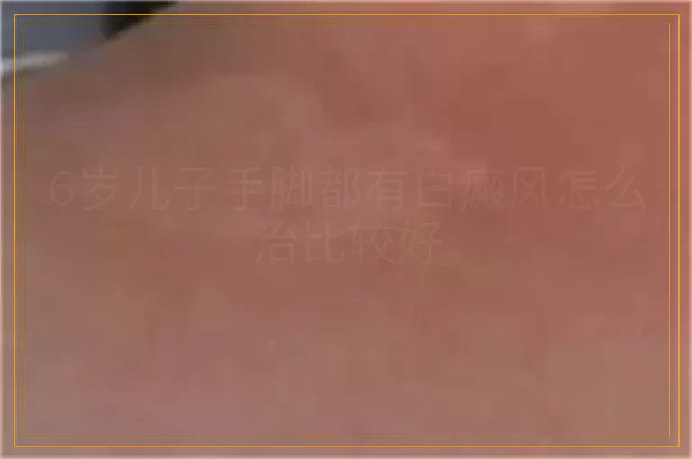 6岁儿子手脚都有白癜风怎么治比较好