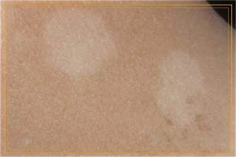 小白点是不是白癜风必须得做伍德氏灯吗