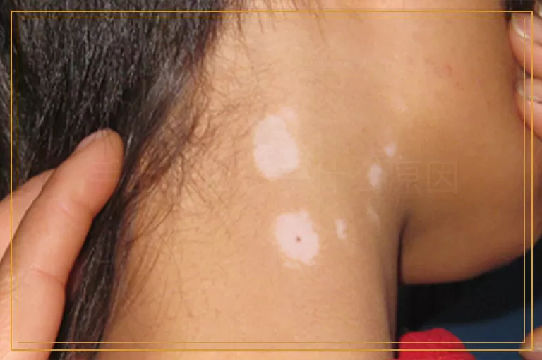 手上长白斑是什么原因