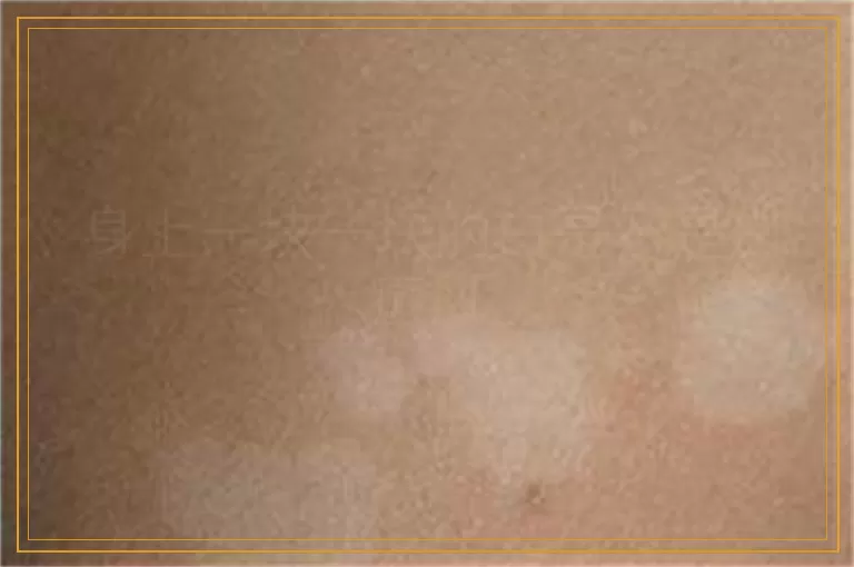 身上一块一块的白是不是白癜风