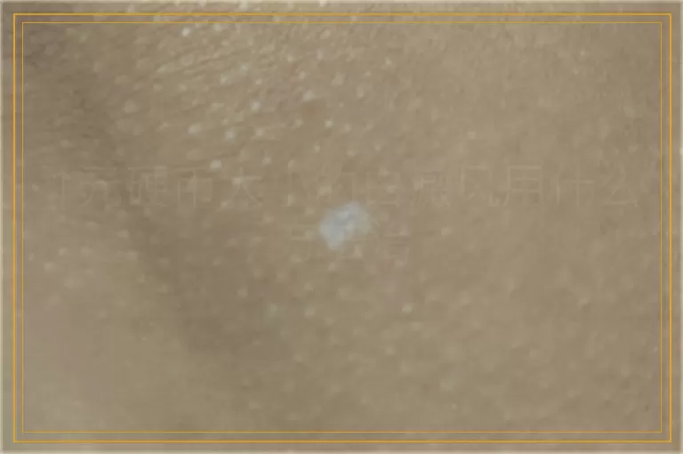 1元硬币大小的白癜风用什么方法治