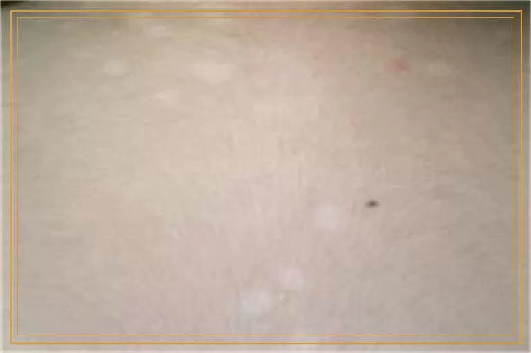 身上出现白斑怎么回事