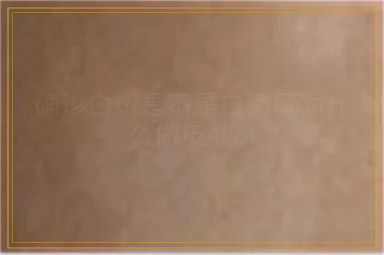确诊白斑是不是白癜风为什么做皮肤ct