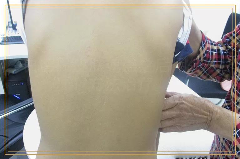 白癜风皮肤遮盖之后用什么方法治疗