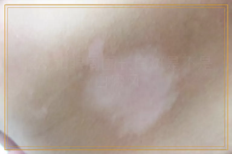眼皮和眼周围长白斑是不是白癜风