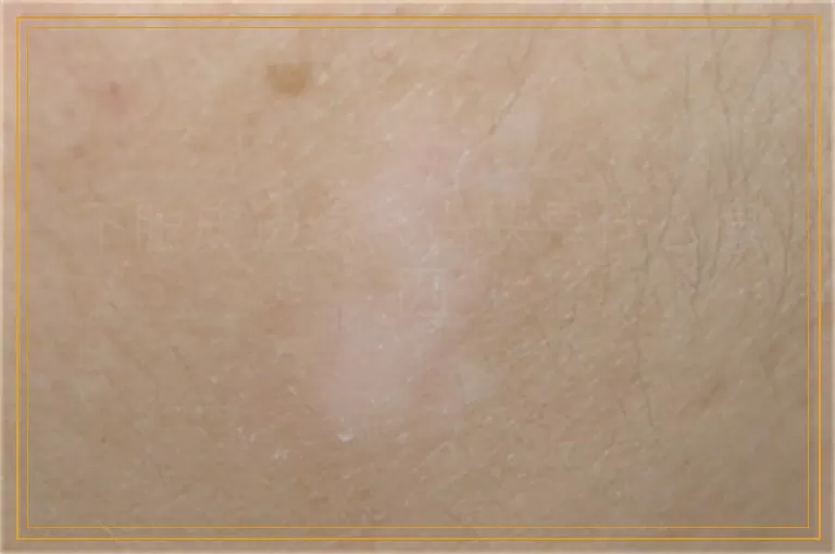 下眼皮边缘长白块是什么原因