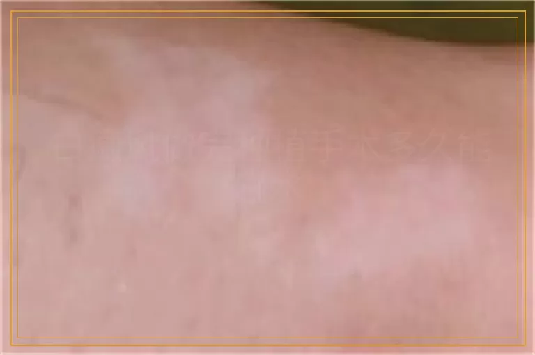 白癜风做完种植手术多久能碰水