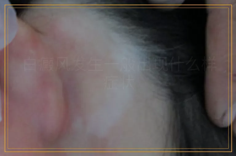 白癜风发生一般出现什么样症状