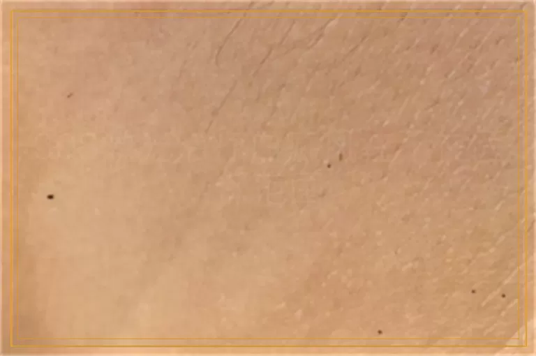 308激光治疗白癜风在不在医保范围