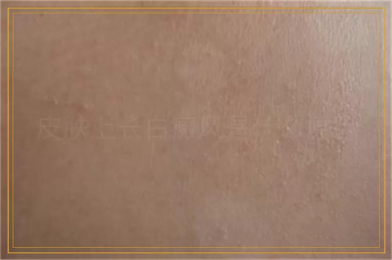 皮肤上长白癜风是什么原因