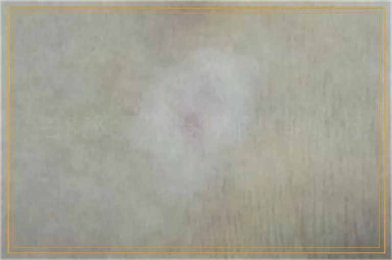 白癜风是不是必须长期吃药