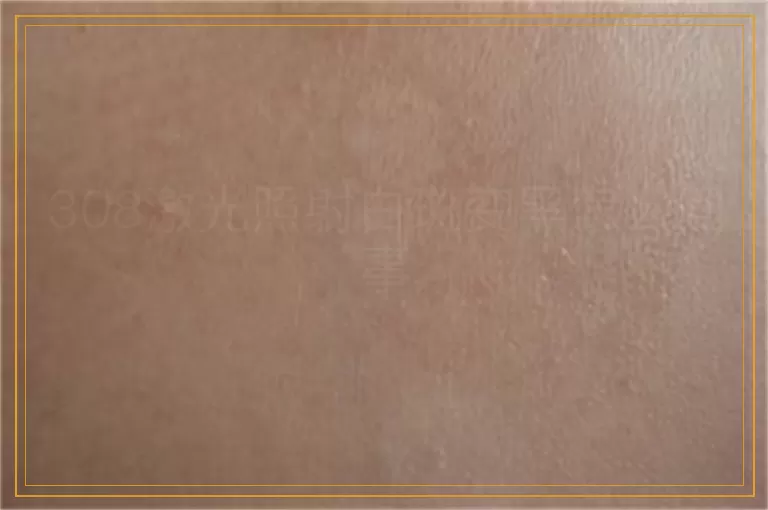 308激光照射白斑变黑怎么回事