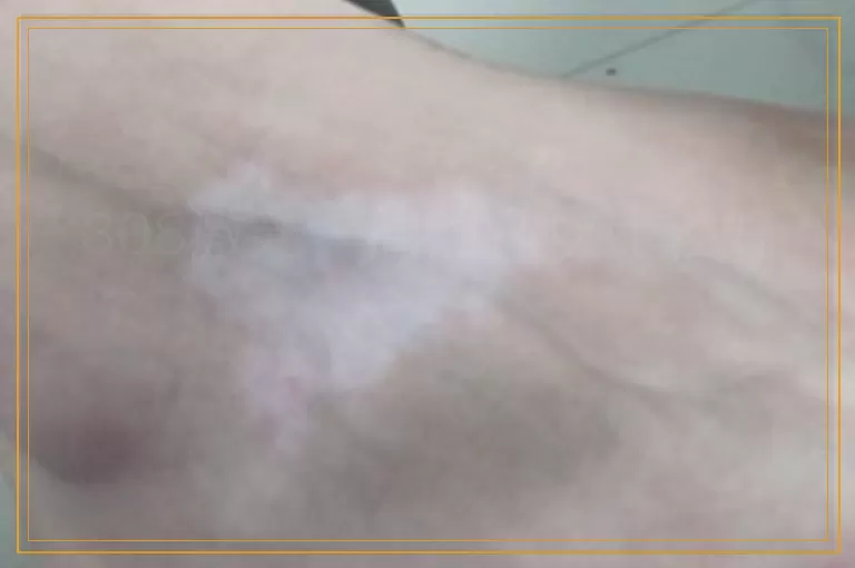 308激光一周照几次比较好