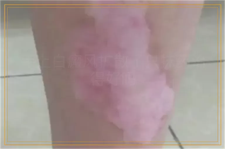 手上白癜风扩散了只抹药治得好吗