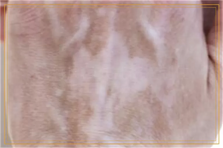 白癜风多久能被控制住