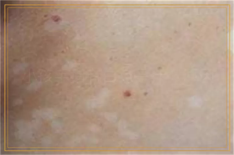 小孩手指有白点是什么原因