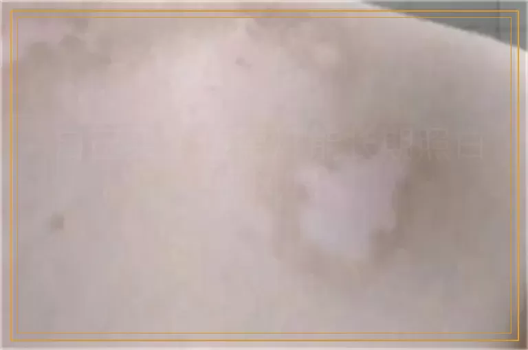 自己买个伍德灯能长期照白癜风吗