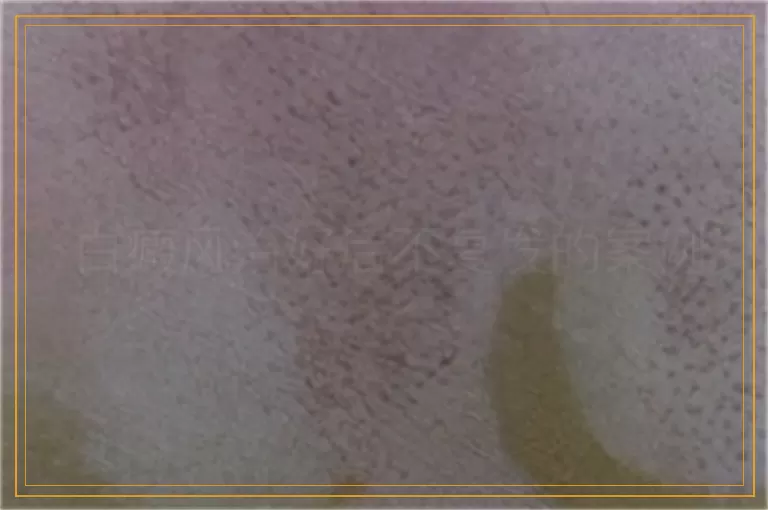 白癜风治好后不复发的案例