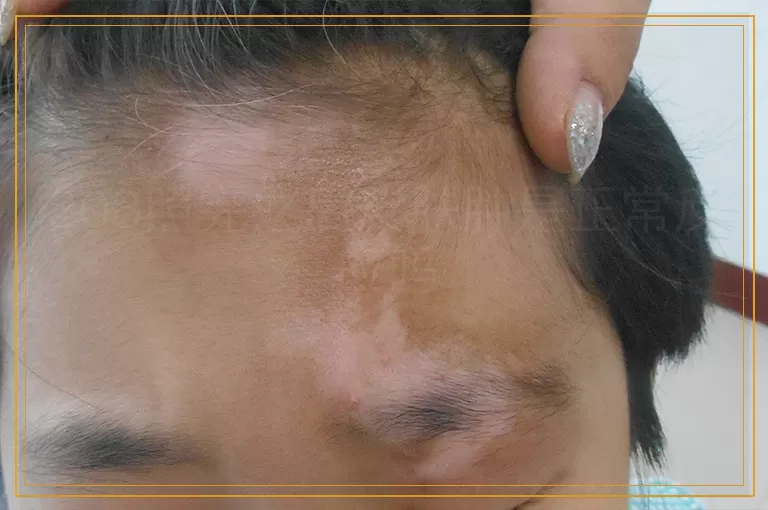 308照完之后皮肤肿是正常反应吗