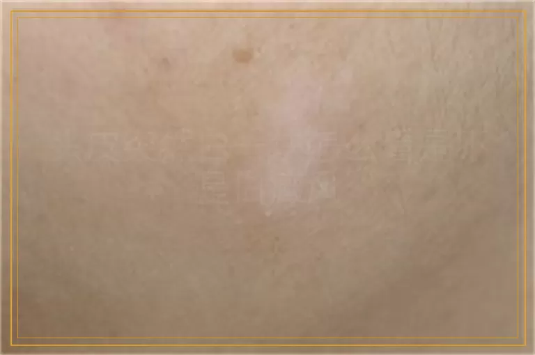 头皮突然白一块怎么看是不是白癜风