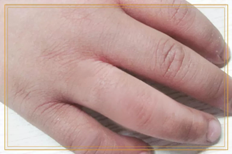 白斑揉搓以后变红是不是白癜风