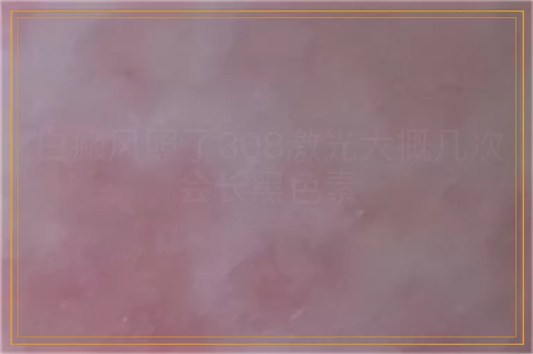白癜风照了308激光大概几次会长黑色素